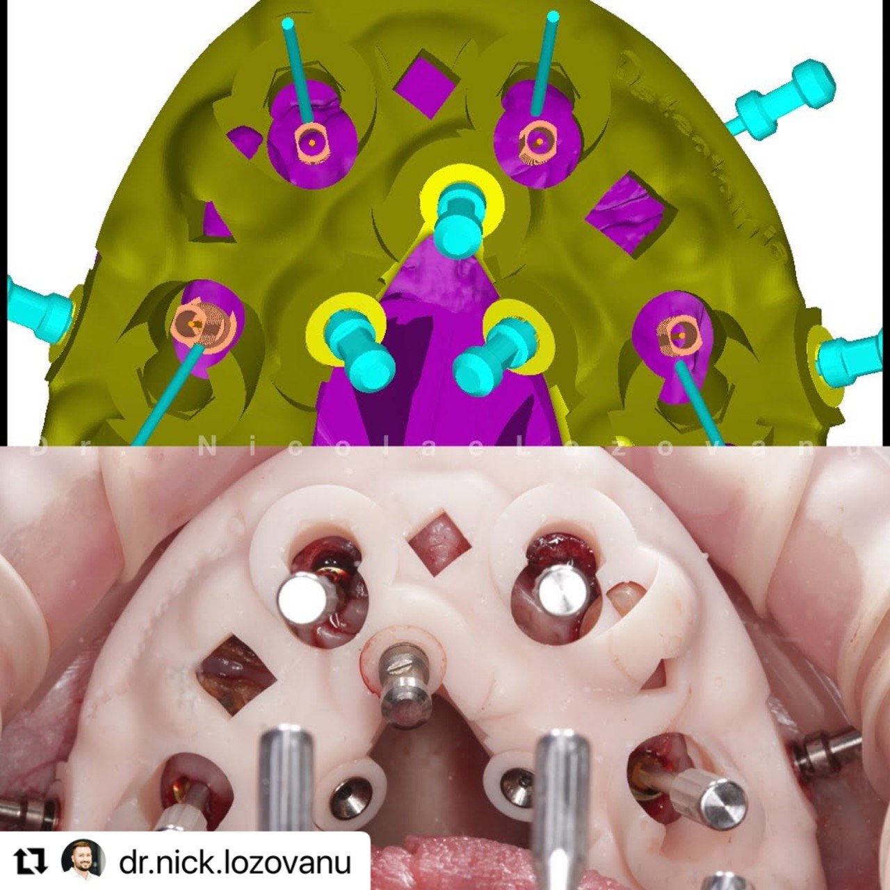 Surgical guides_in the mouth_Lozovanu_ImplaStation