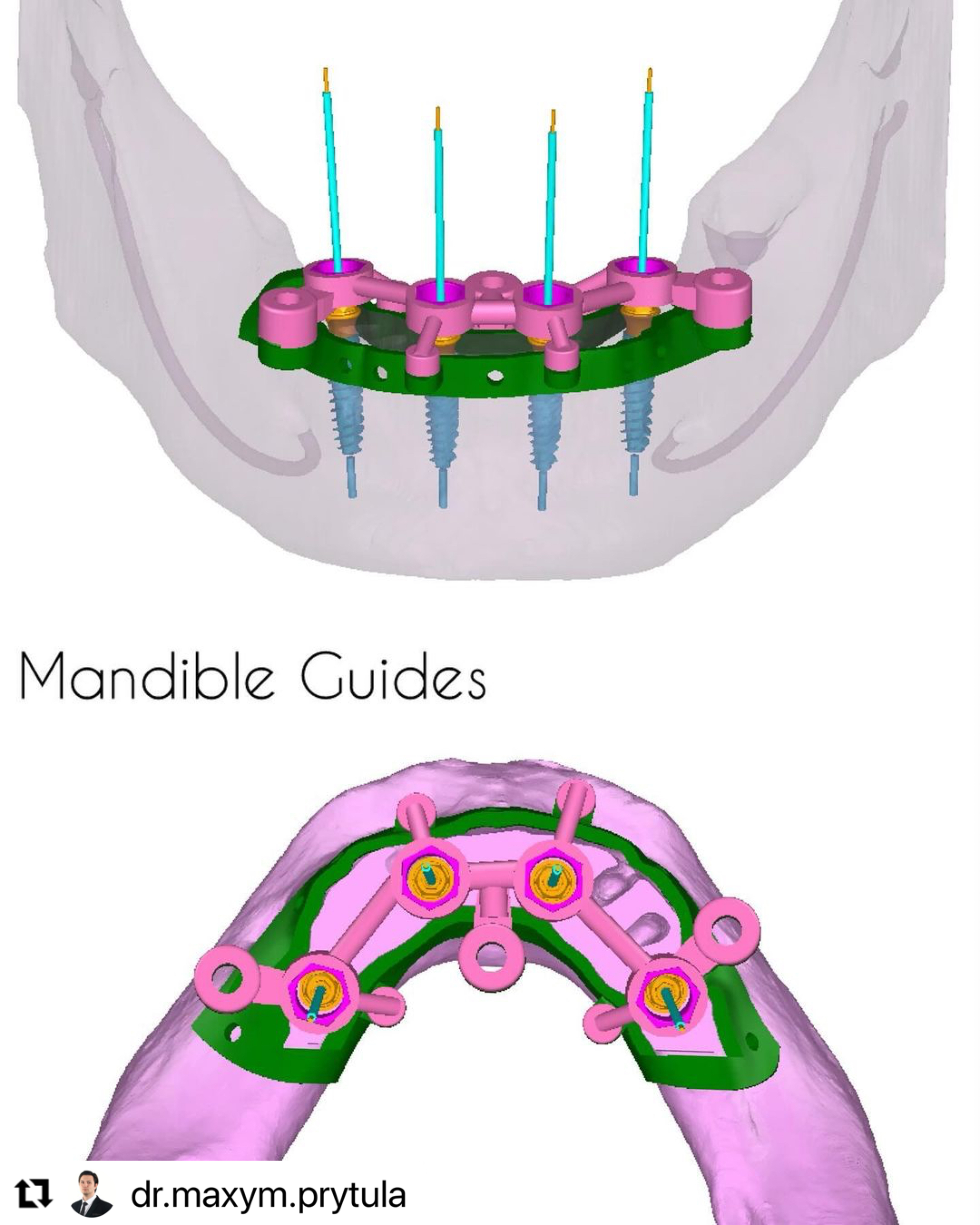 Mandible_guide_ImplaStation