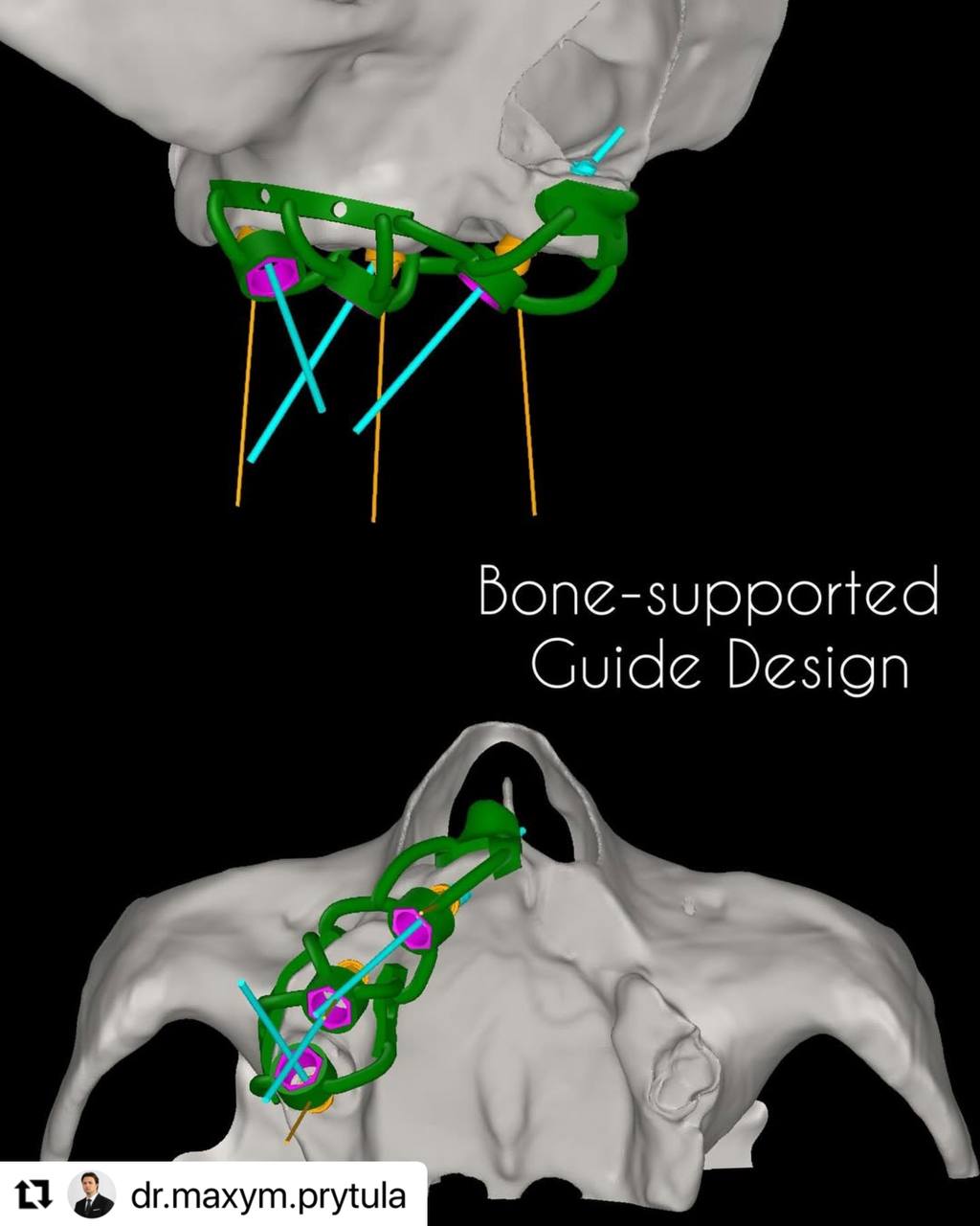 bone_supported_guide_design_implastation