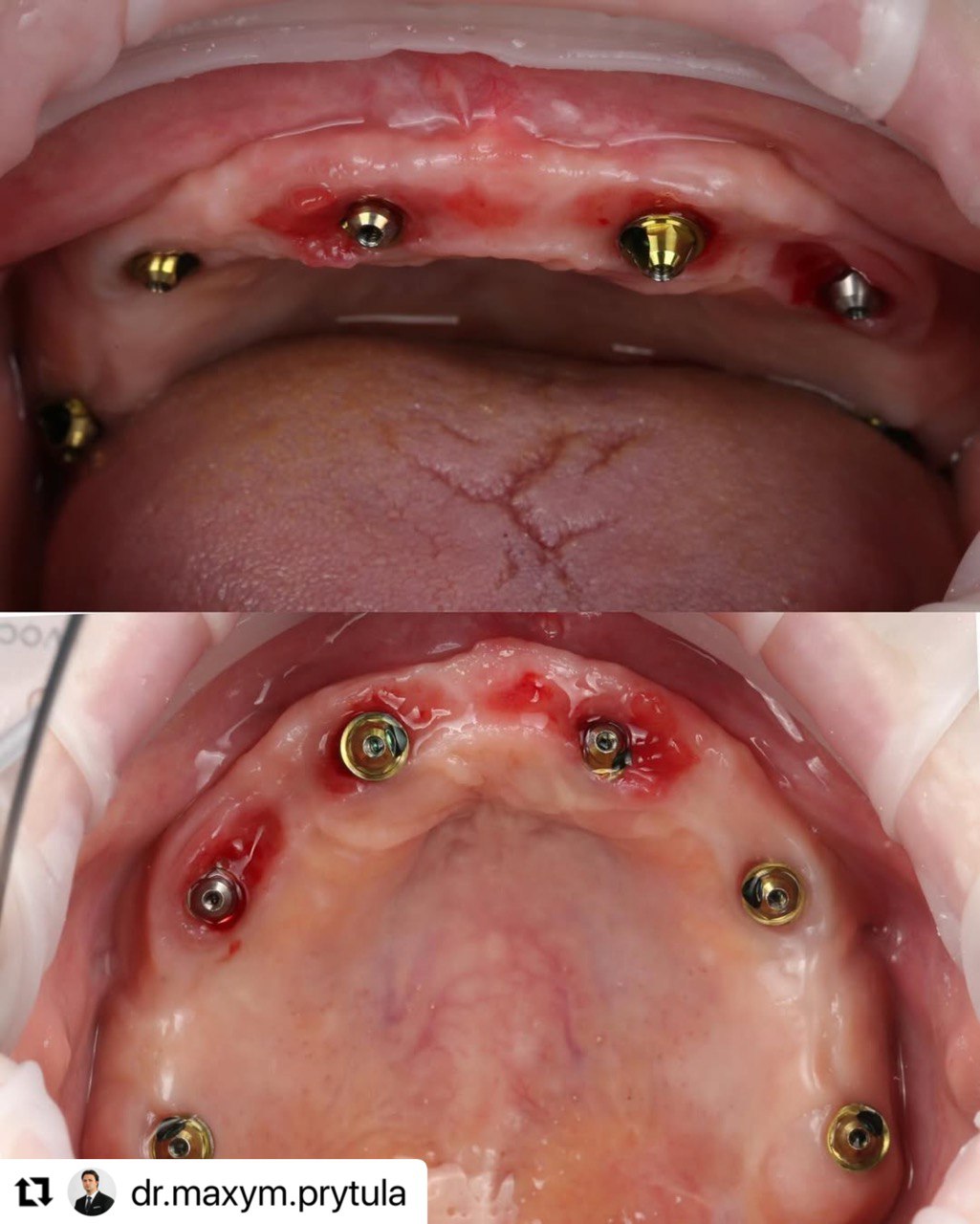 hybrid-zygomatic_config_ImplaStation