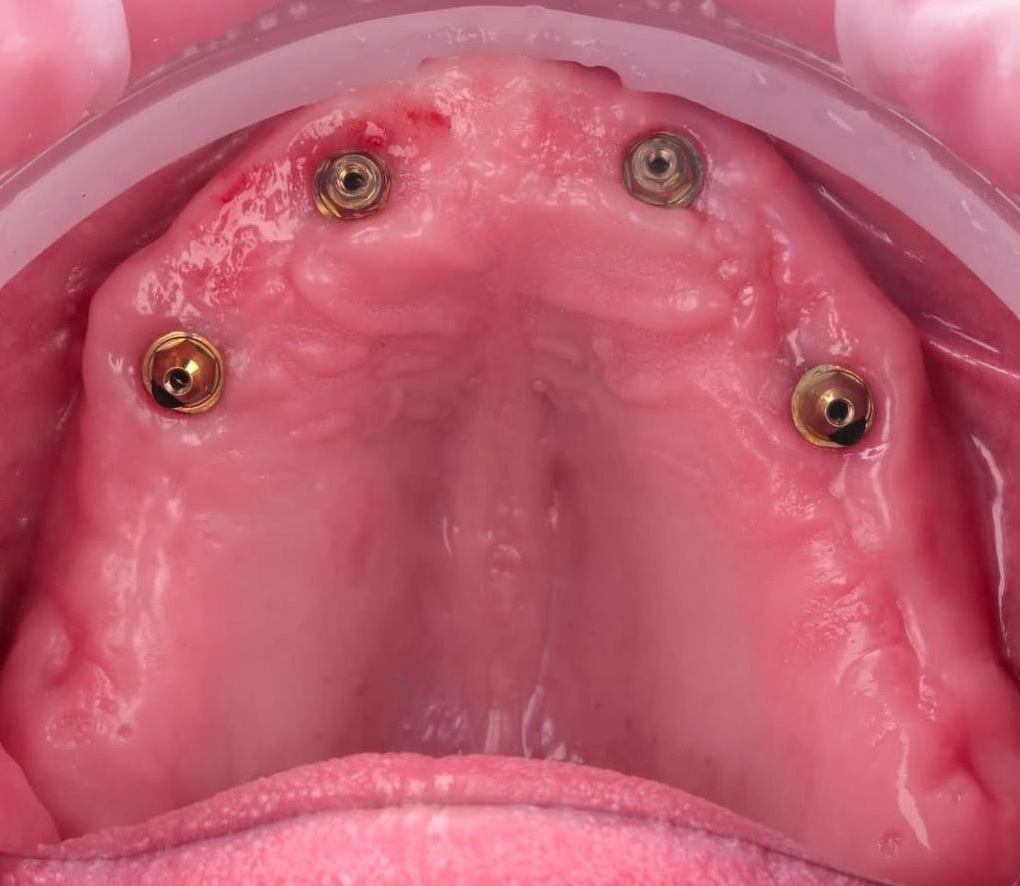 Maxilla Full-arch Fully-guided with immediate loading during surgery