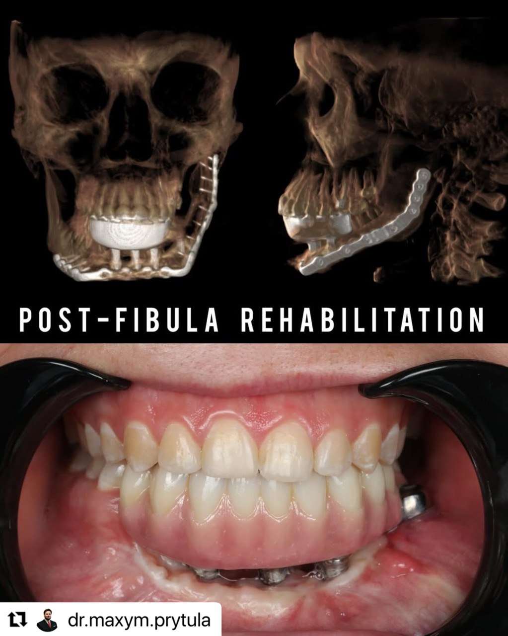 Post-Fibula Rehabilitation