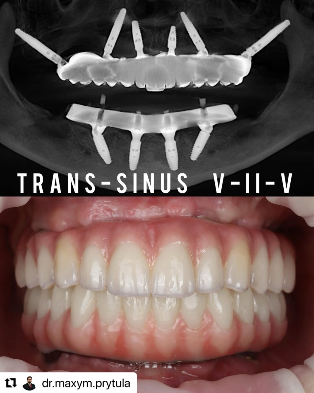 Trans-Sinus V-II-V
