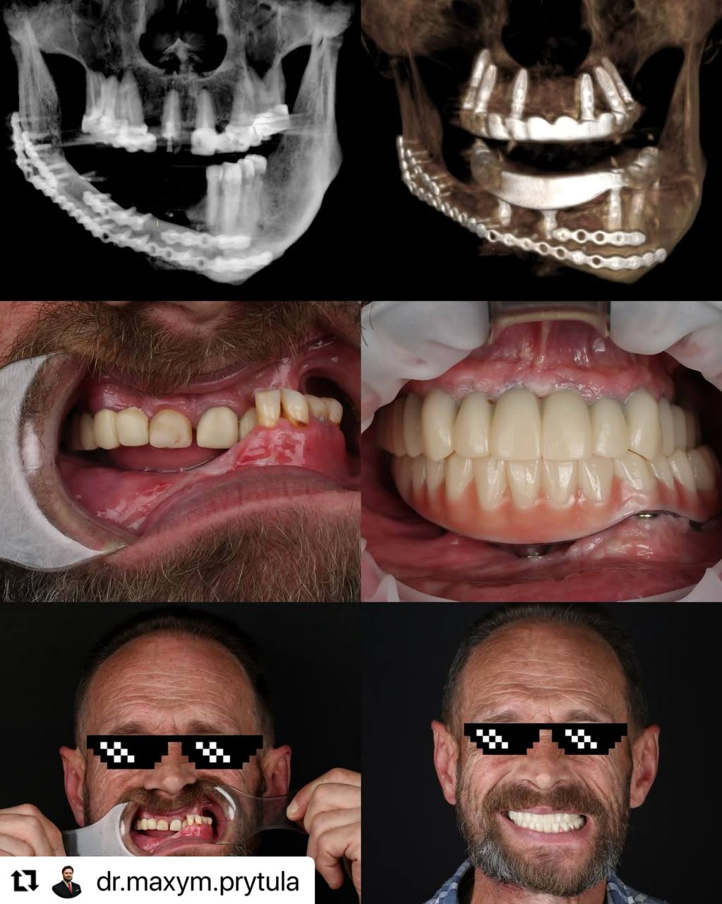Complex Multidisciplinary Rehabilitation After War‑Induced Mandibular Trauma